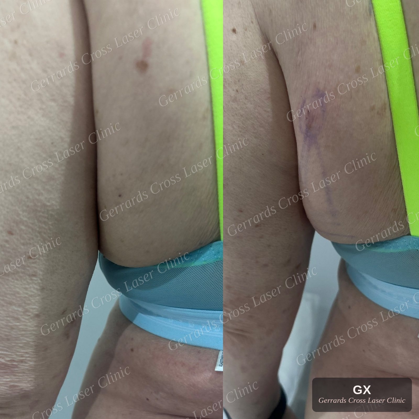 Endolift before and after, back and underarm
