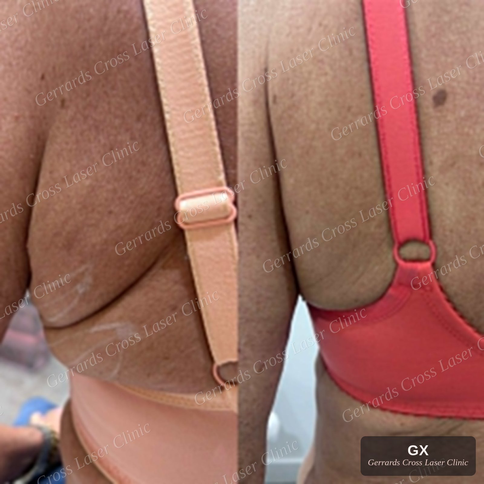 Endolift before and after, bra-line area