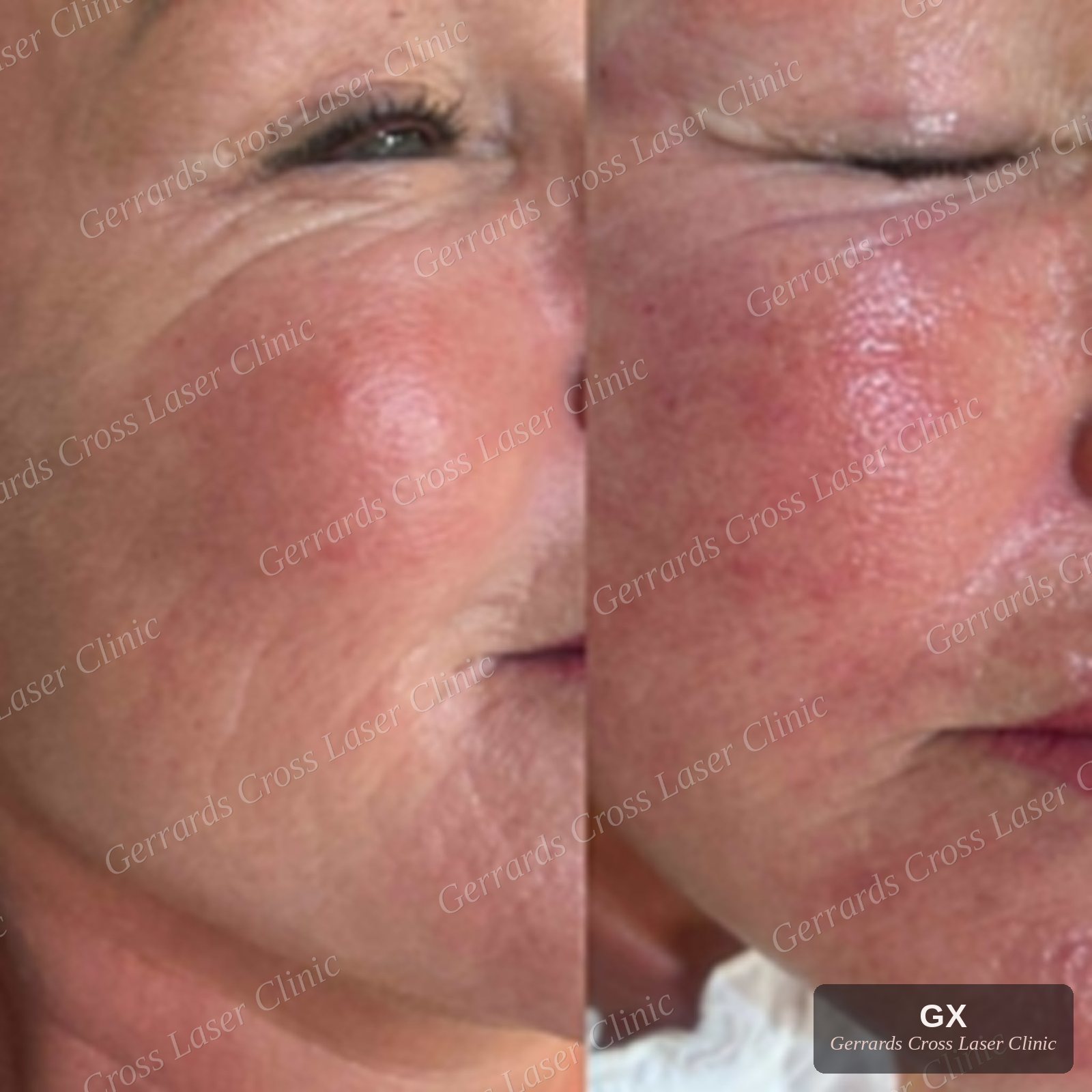 Endolift before and after, cheek and eye area