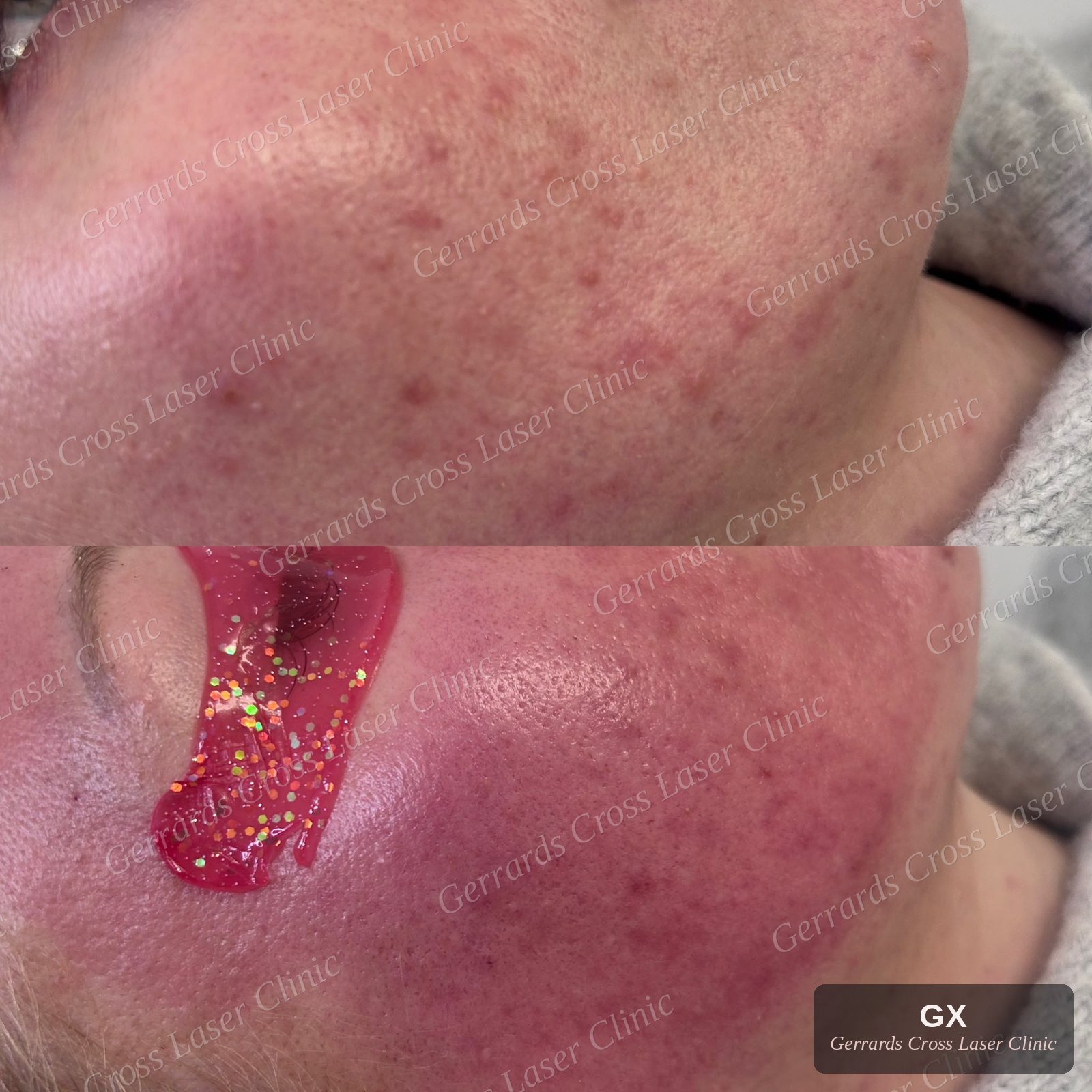 Micro-needling before and after, cheek skin texture